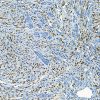 Kaposi sarcoma stained with HHV-8 [13B10] antibody