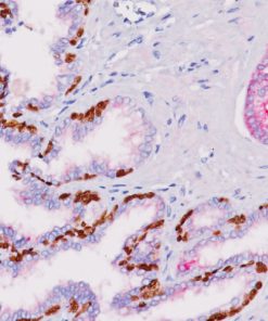 Prostate cancer stained with p63 + P504S