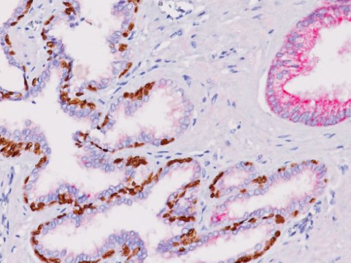 Prostate cancer stained with p63 + P504S