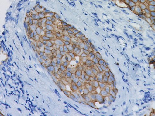 Breast cancer stained with c-erbB-2/HER2 antibody