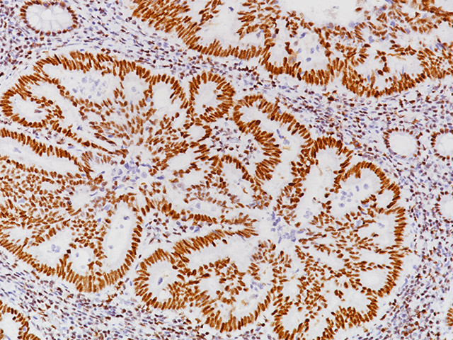 Colon cancer stained with PMS2 antibody