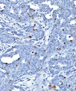 Breast cancer stained with BRCA-1 antibody