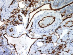 Colon cancer stained with CD31 antibody