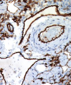 Colon cancer stained with CD31 antibody