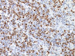 Multiple myeloma stained with MUM-1 antibody