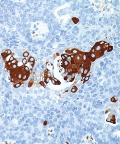 Ovarian cancer stained with VEGF antibody