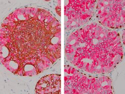 (Left) Hyperplasia of the Usual Type (Right) Atypical Ductal Hyperplasia