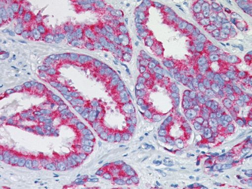 Prostate cancer stained with P504S antibody, 2X