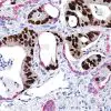 Colon cancer (brown) metastasized into lung tissue (red).