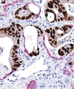 Colon cancer (brown) metastasized into lung tissue (red).