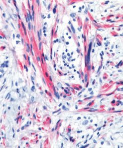 Neurotrophic melanoma stained with Nerve Growth Factor Receptor Antibody