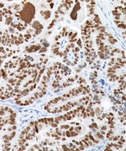 Serous ovarian adenocarcinoma stained with PAX8 Rabbit Antibody
