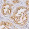 Lung adenocarcinoma stained with Napsin A mouse antibody