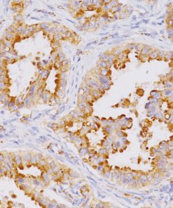 Lung adenocarcinoma stained with Napsin A mouse antibody
