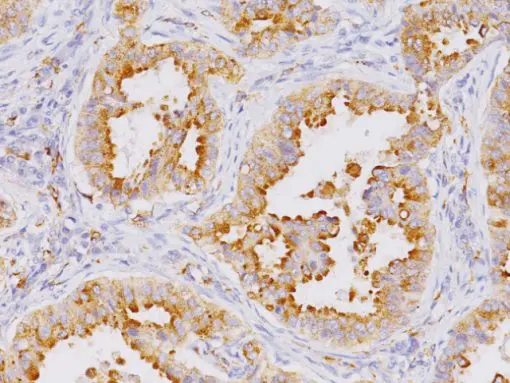 Lung adenocarcinoma stained with Napsin A mouse antibody