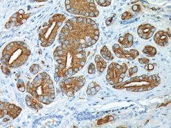Prostate stained with Prostate Specific Antigen Antibody