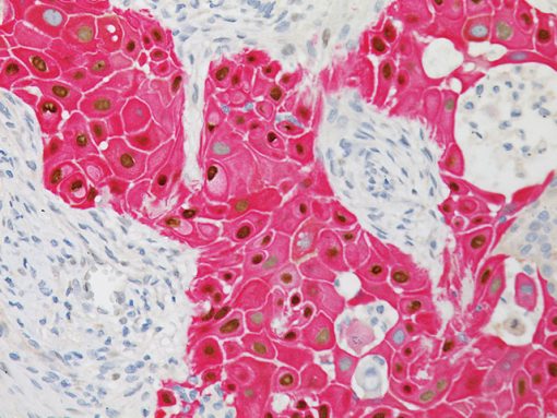Squamous cell carcinoma stained with p63 + CK5 antibody
