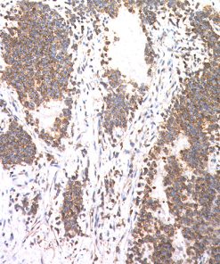 Ewing's sarcoma stained with CD99 antibody