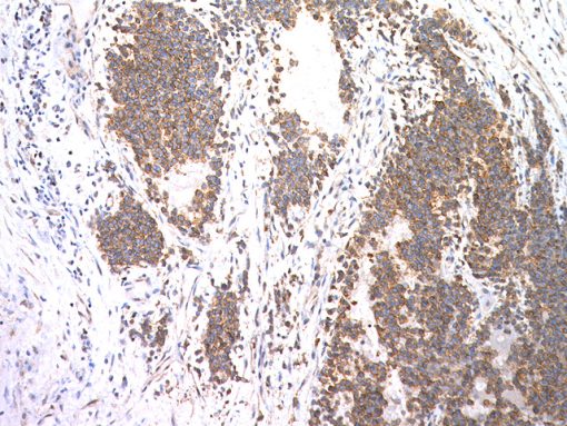 Ewing's sarcoma stained with CD99 antibody