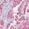 TTF-1 + Napsin A staining lung adenocarcinoma