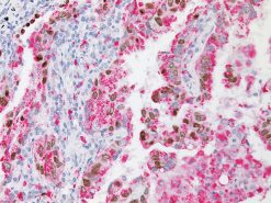 TTF-1 + Napsin A staining lung adenocarcinoma