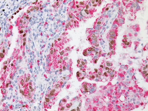 TTF-1 + Napsin A staining lung adenocarcinoma