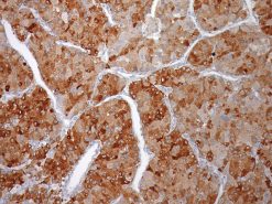 Liver cancer stained with Glypican-3 antibody
