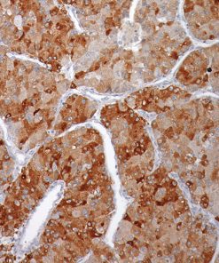 Liver cancer stained with Glypican-3 antibody