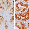 Lung adenocarcinoma from L to R: 2+ staining, 3+ staining with Folate Receptor alpha antibody