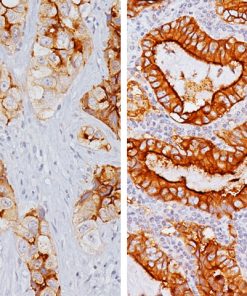 Lung adenocarcinoma from L to R: 2+ staining, 3+ staining with Folate Receptor alpha antibody