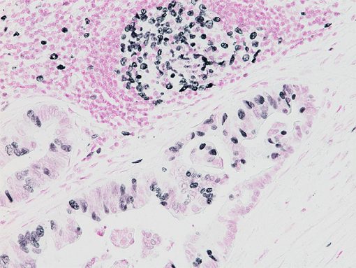 Ki-67 on Human Colon Cancer counter-stained with Feulgen’s