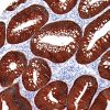 Colon cancer stained with MOC-31 antibody