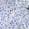 Melanoma stained with Phospho-Histone H3 antibody