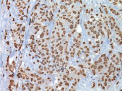 Breast cancer stained with GATA-3 antibody