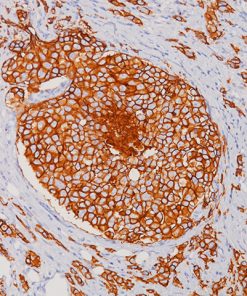 Human breast cancer stained with a humanized Her2neu antibody using Biocare’s Human-on-Human HRP-Polymer kit