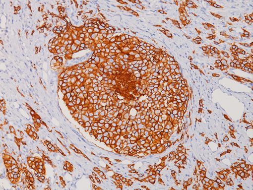 Human breast cancer stained with a humanized Her2neu antibody using Biocare’s Human-on-Human HRP-Polymer kit