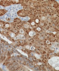 Colon cancer stained with β-Catenin antibody.