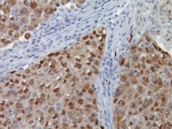 Breast cancer stained with Heat Shock Protein 70 antibody