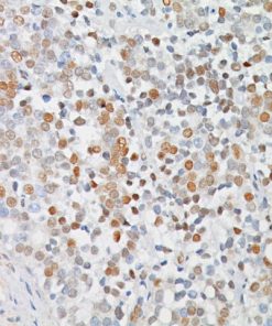 Prostate cancer stained with c-Myc antibody