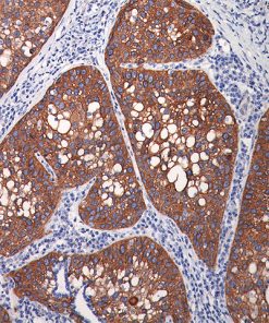 Lung squamous carcinoma stained with TRIM29 antibody