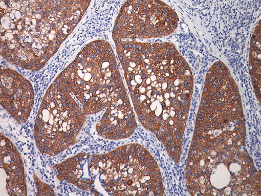 Lung squamous carcinoma stained with TRIM29 antibody