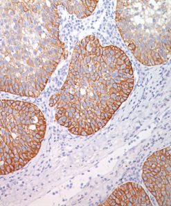 Lung squamous cell carcinoma stained with Desmoglein 3 antibody