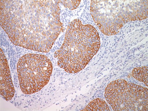 Lung squamous cell carcinoma stained with Desmoglein 3 antibody