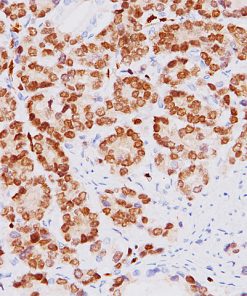 Prostate cancer stained with ERG antibody