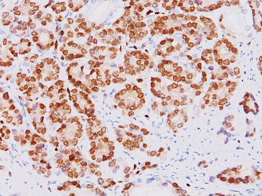 Prostate cancer stained with ERG antibody