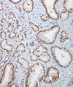Prostate cancer stained with NKX3.1 antibody