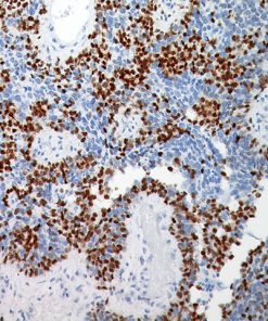 Metastatic melanoma stained with Microphthalmia Transcription Factor Antibody