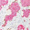 Lung squamous cell carcinoma stained with TTF-1 (DAB) + CK5 (FR)