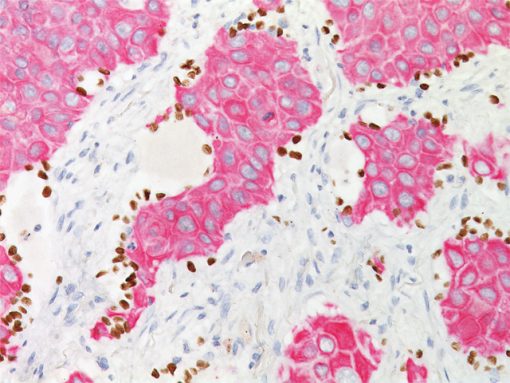 Lung squamous cell carcinoma stained with TTF-1 (DAB) + CK5 (FR)