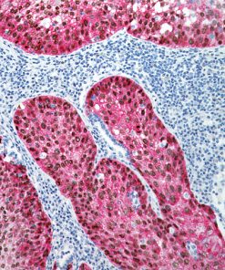Lung squamous cell carcinoma stained with p63 (DAB) antibody + TRIM29 (FR) antibody
